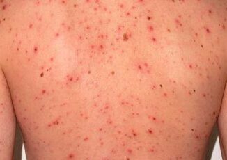 Alerta epidemiológica por sarampión en México, Chihuahua con más casos