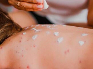 Aumentan a 421 los casos de sarampión en México